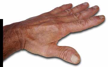 charles Prowell's hand